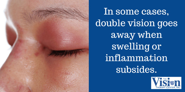 Double vision can go away when swelling subsides.