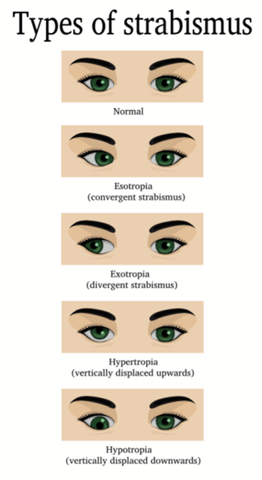 Types of Strabismus